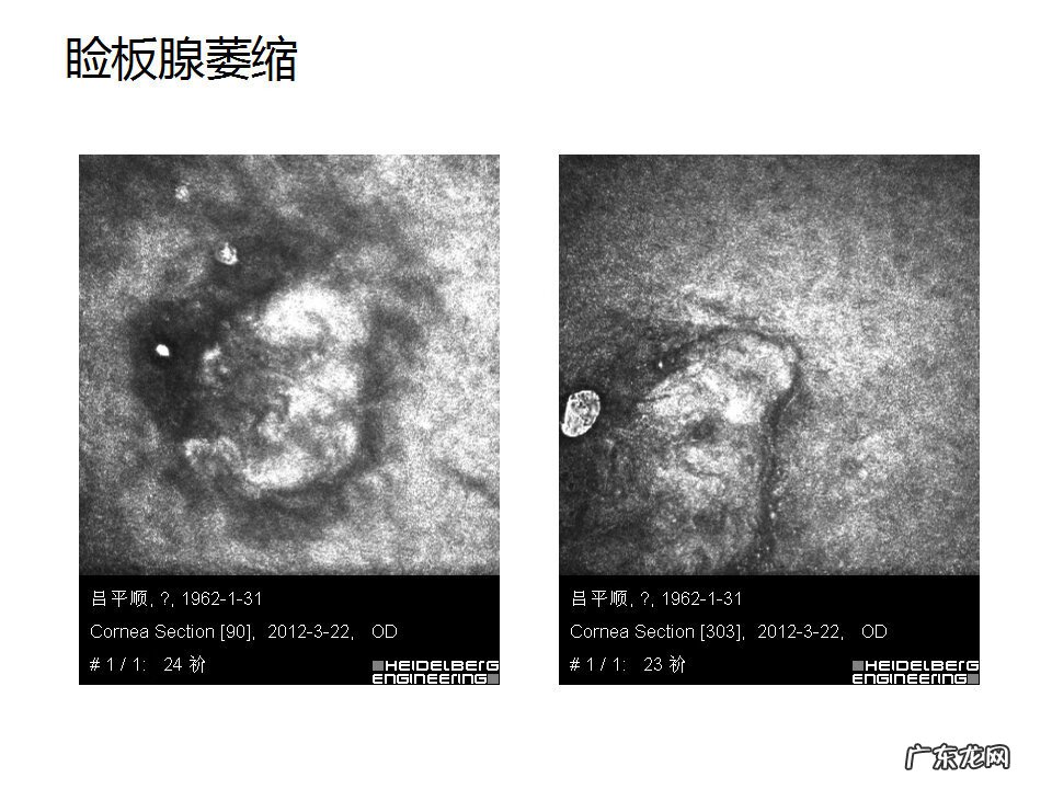 眼睑炎症的症状 眼睑炎怎么引起的