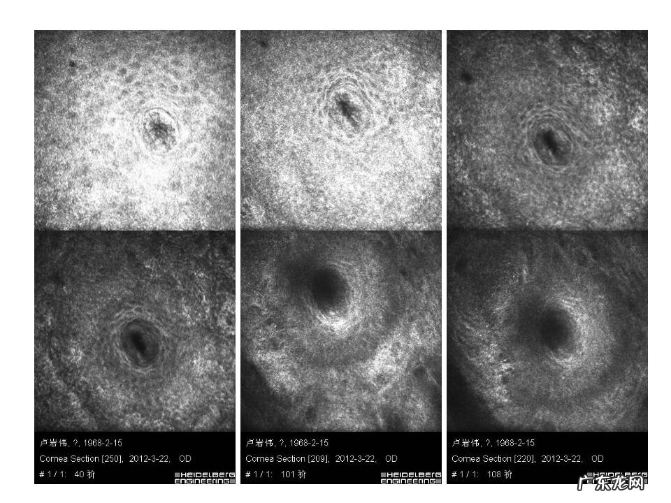 眼睑炎症的症状 眼睑炎怎么引起的