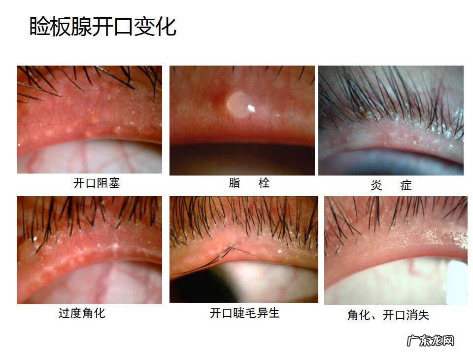 眼睑炎症的症状 眼睑炎怎么引起的