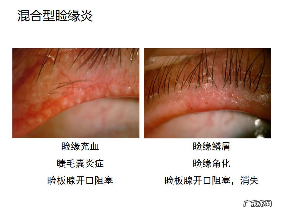 眼睑炎症的症状 眼睑炎怎么引起的