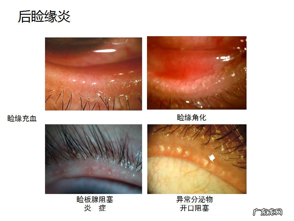 眼睑炎症的症状 眼睑炎怎么引起的
