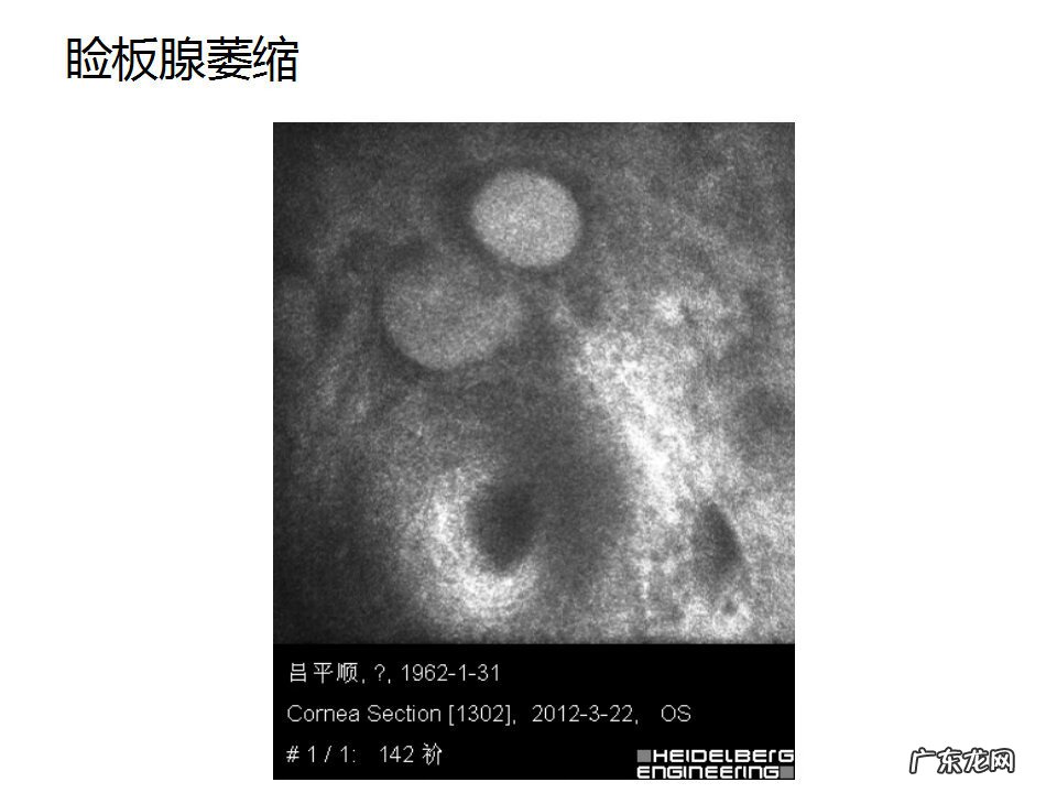 眼睑炎症的症状 眼睑炎怎么引起的