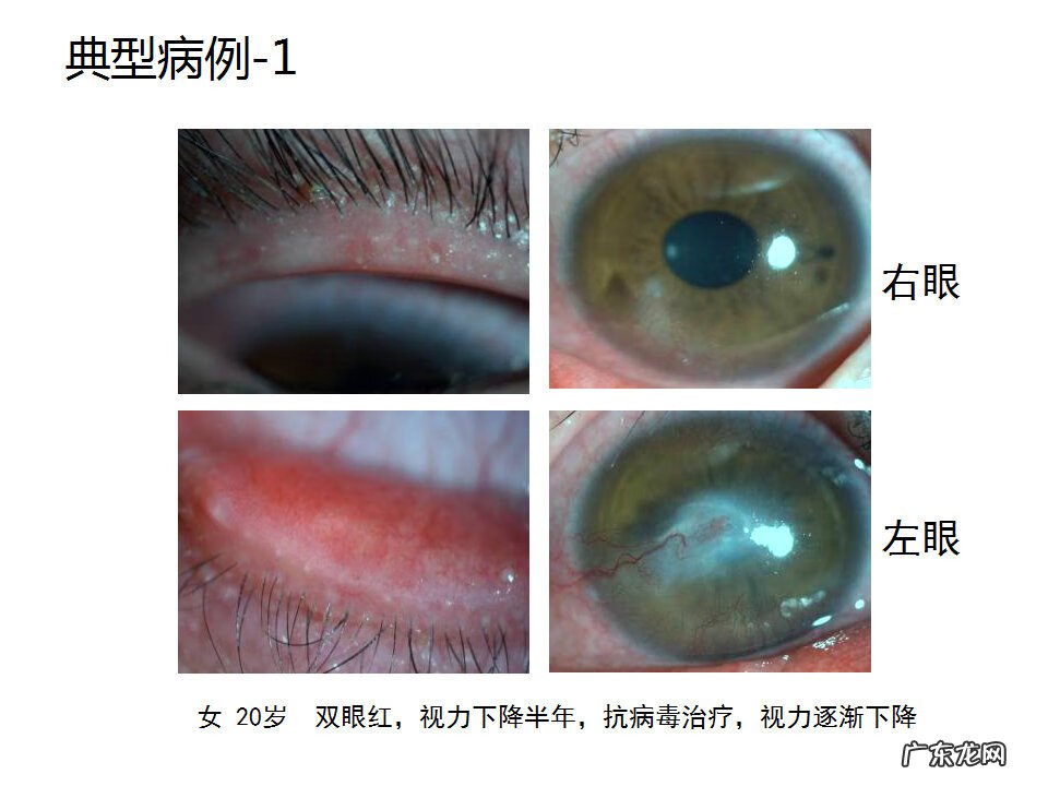 眼睑炎症的症状 眼睑炎怎么引起的