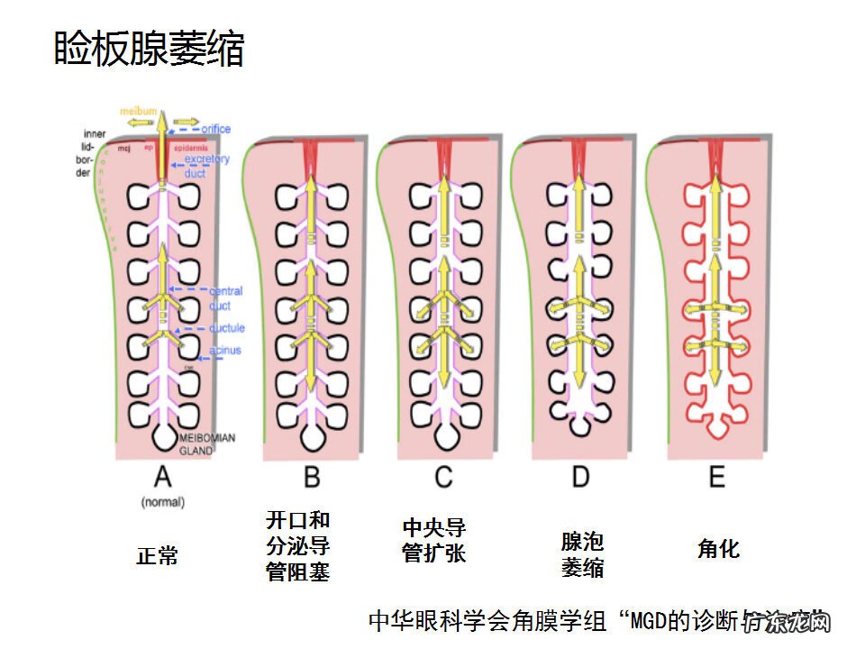 眼睑炎症的症状 眼睑炎怎么引起的