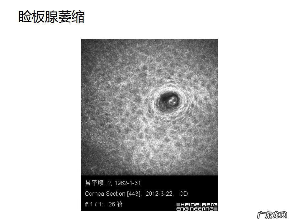 眼睑炎症的症状 眼睑炎怎么引起的