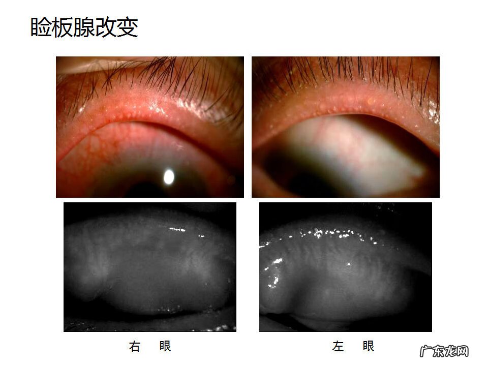 眼睑炎症的症状 眼睑炎怎么引起的