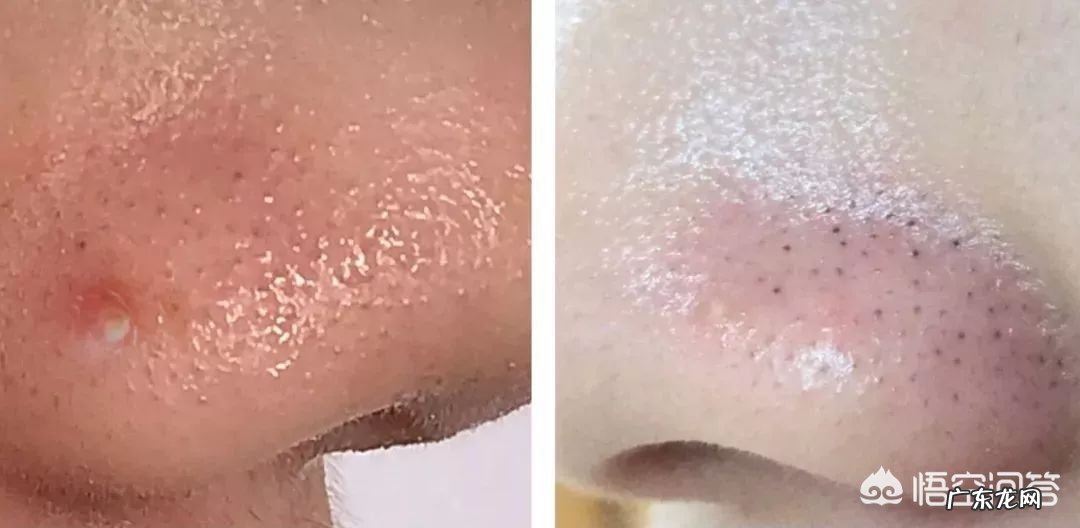 怎样去黑头粉刺?