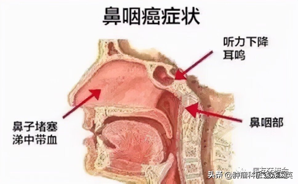 鼻咽癌前期的18种预兆 鼻咽癌