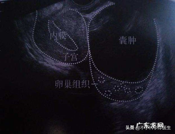 做了卵巢囊肿手术怀孕有好处吗?