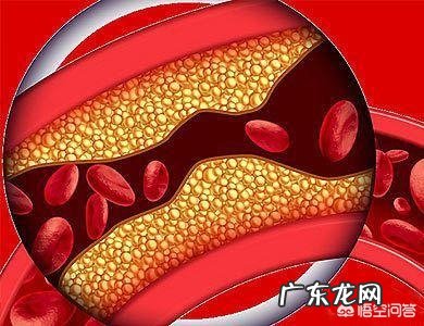 心绞痛会发展为心肌梗死吗？该如何预防？