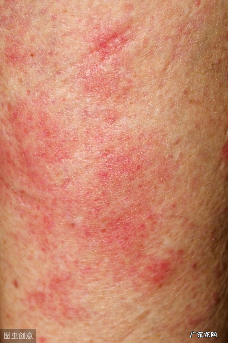 荨麻疹会传染给家人吗 荨麻疹传染吗