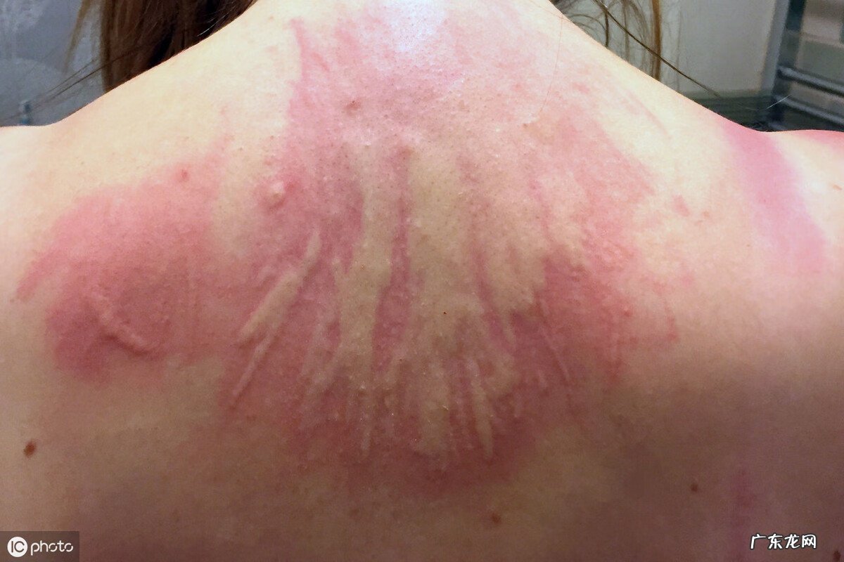 荨麻疹会传染给家人吗 荨麻疹传染吗