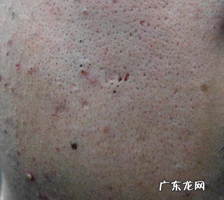 脸颊突然毛孔粗大怎么办 两颊毛孔粗大怎么办啊