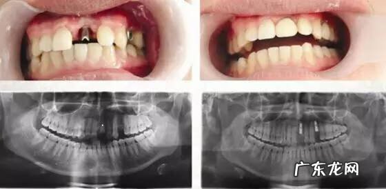 牙坏了戴牙套好不好 戴牙套风水学好吗