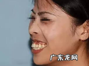 牙坏了戴牙套好不好 戴牙套风水学好吗