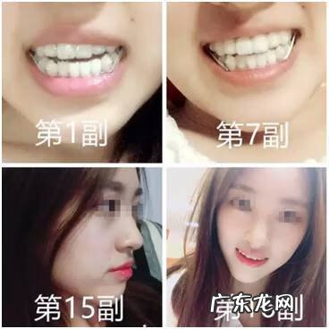 牙坏了戴牙套好不好 戴牙套风水学好吗