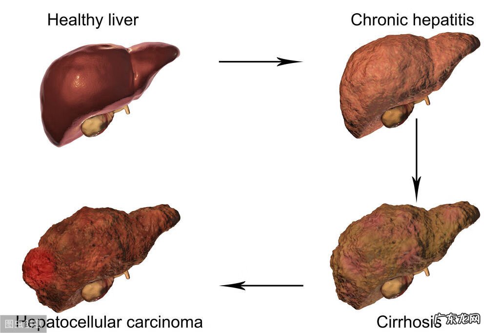 肝硬化具体有哪些症状 肝硬化的症状有那些