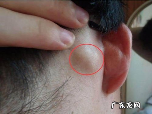 耳根子后面长了个疙瘩不疼 耳朵跟后面长了个疙瘩还疼怎么回事