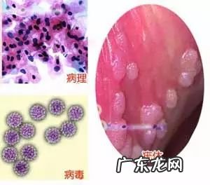 女性得了尖湿锐会不会不好治 尖锐湿油