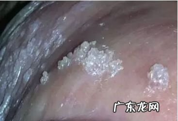 女性得了尖湿锐会不会不好治 尖锐湿油