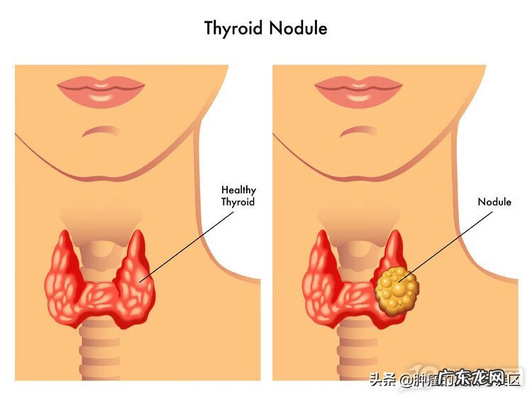 结节什么形状的不好 结节问题大吗