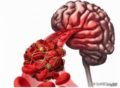 脑供血不足吃啥药好使 脑供血不足吃什么药效果最快
