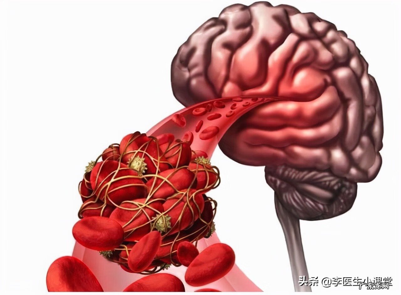 脑供血不足吃啥药好使 脑供血不足吃什么药效果最快