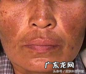 黄褐斑能不能彻底去掉 长黄褐斑
