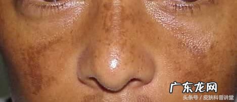 黄褐斑能不能彻底去掉 长黄褐斑