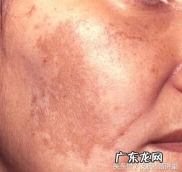 黄褐斑能不能彻底去掉 长黄褐斑