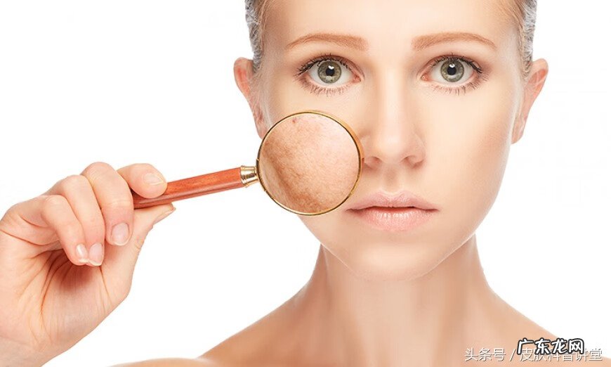 黄褐斑能不能彻底去掉 长黄褐斑