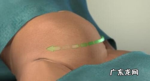 剖腹产的真实过程 剖腹产过程及步骤组图