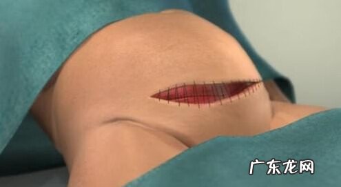 剖腹产的真实过程 剖腹产过程及步骤组图
