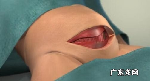 剖腹产的真实过程 剖腹产过程及步骤组图