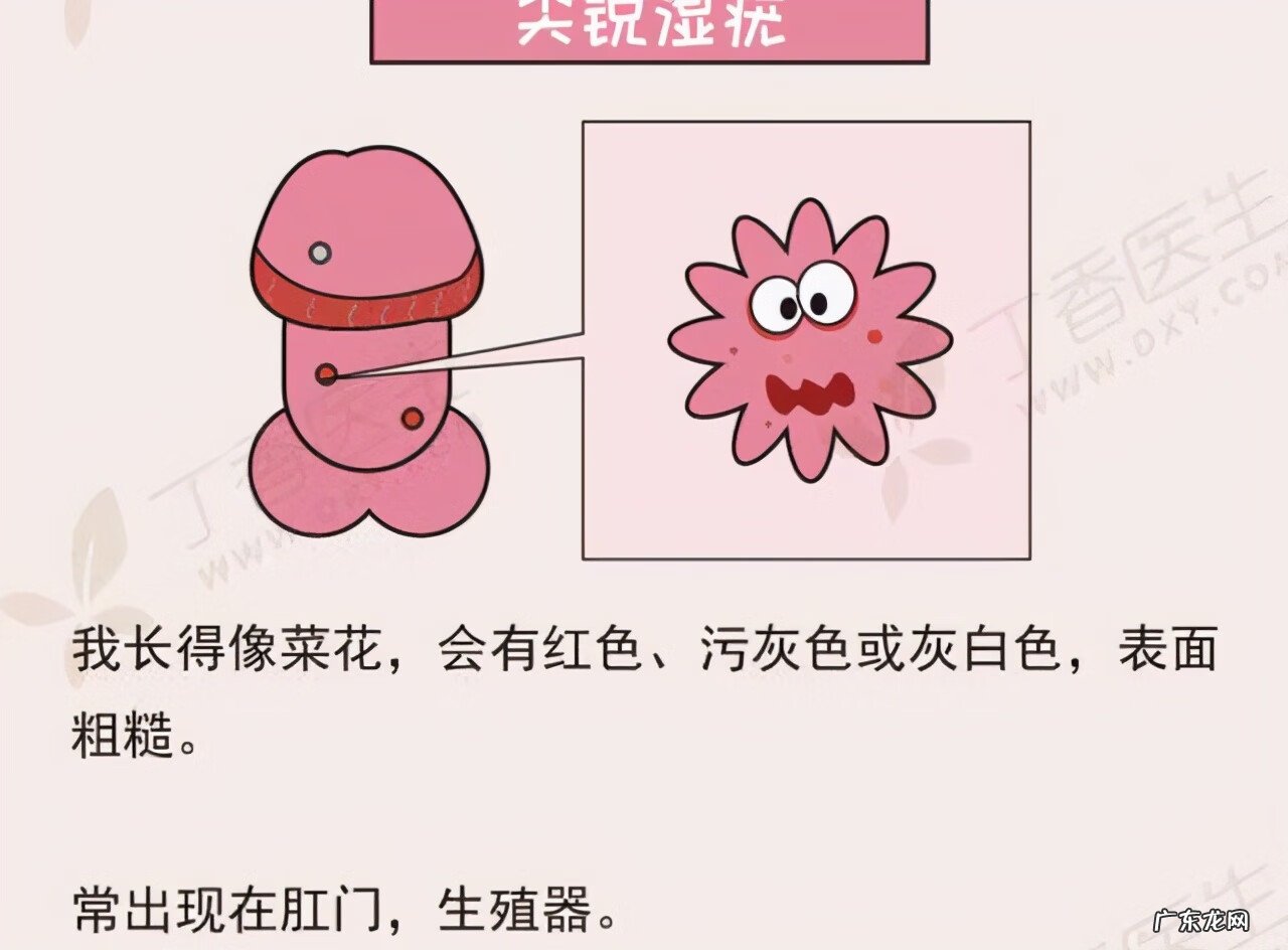 男性尖锐性湿疹疣早期症状 湿锐尖疣的早期症状