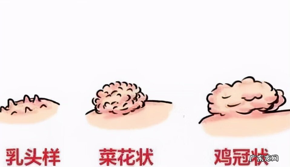 男性尖锐性湿疹疣早期症状 湿锐尖疣的早期症状