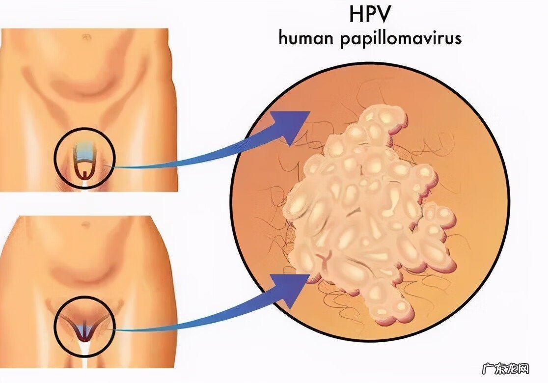 男性尖锐性湿疹疣早期症状 湿锐尖疣的早期症状