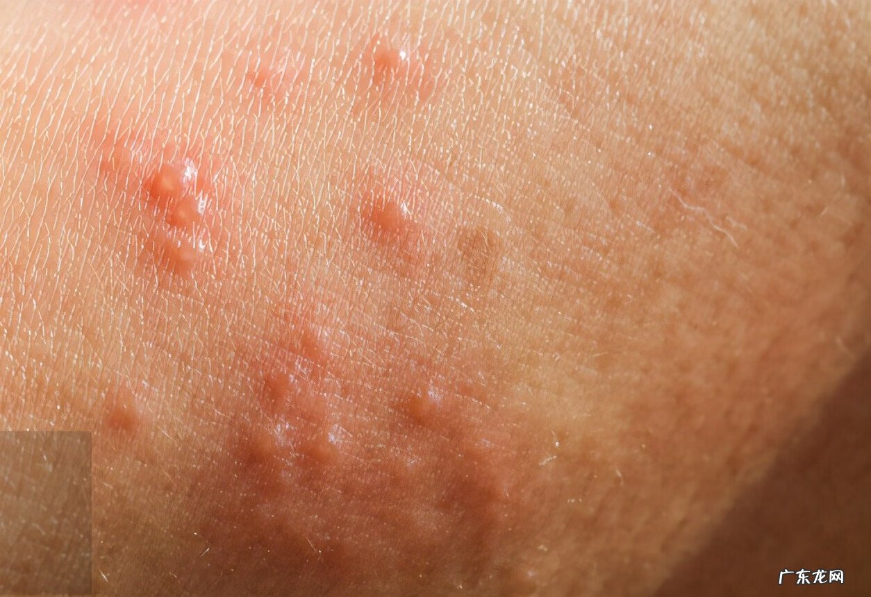 湿疹怎么能治好 如何治湿疹病