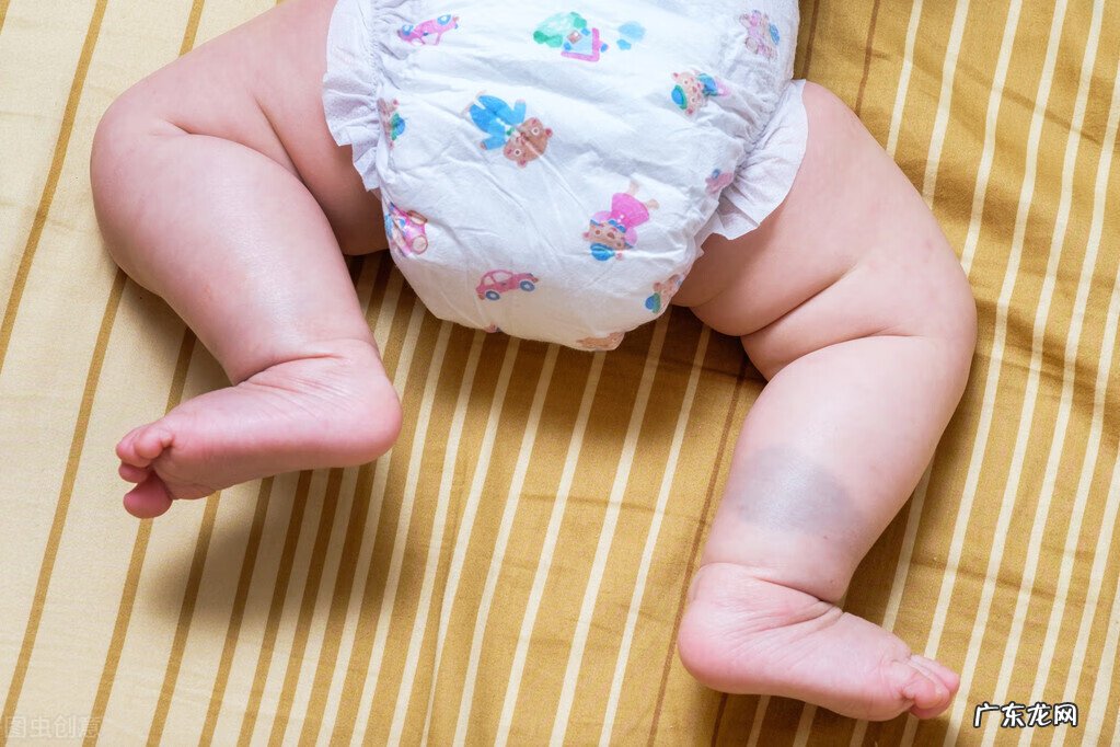 咖啡色胎记激光几次可以去除 激光去胎记一次能做干净吗