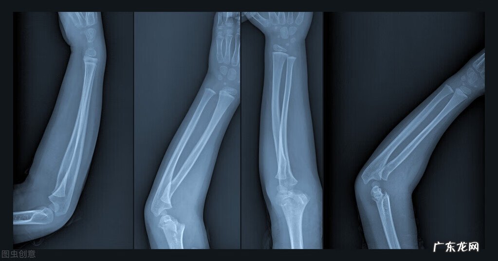 骨折了吃什么好的最快 骨折吃什么好的比较快