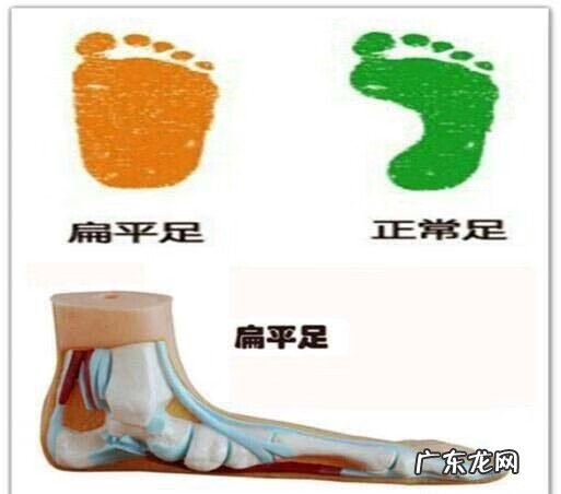 扁平足是什么病 平足症是什么