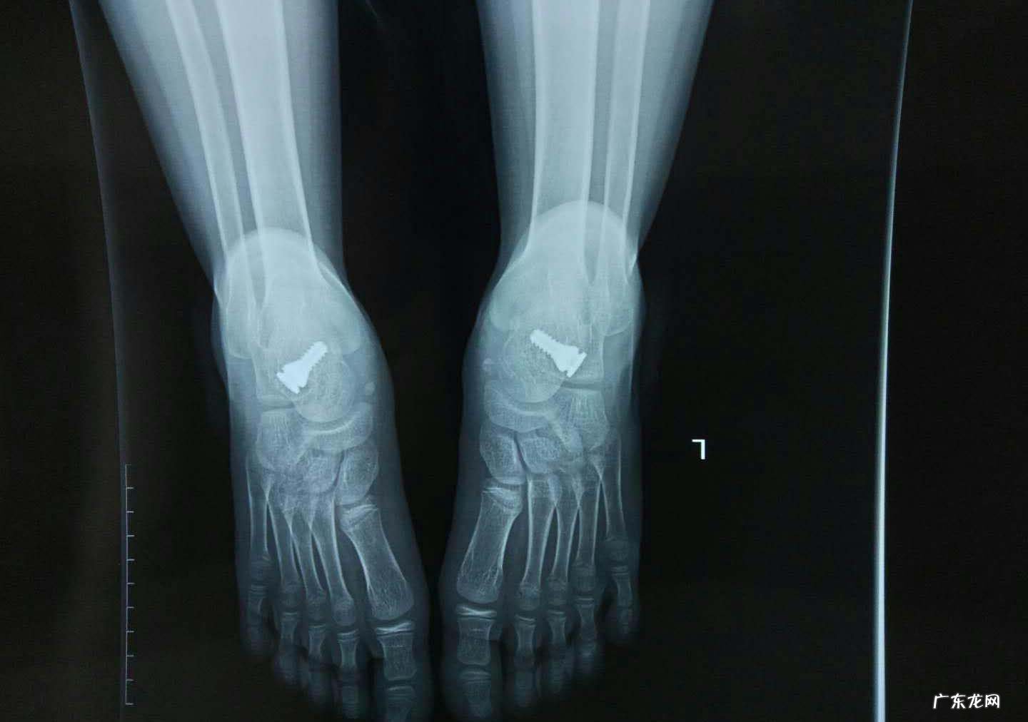 扁平足是什么病 平足症是什么