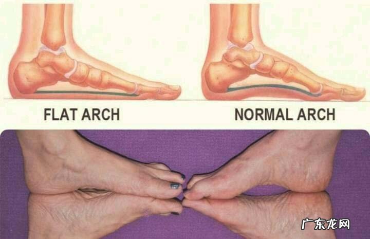 扁平足是什么病 平足症是什么