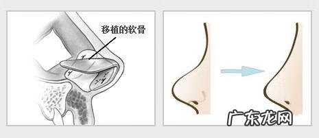 耳软骨隆鼻 耳软骨隆鼻手术过程