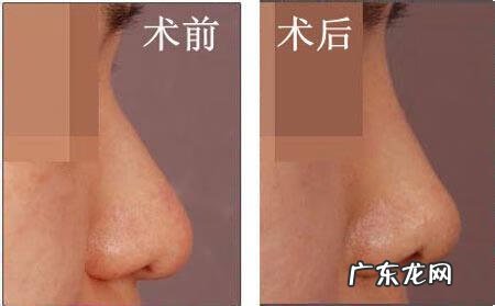 耳软骨隆鼻 耳软骨隆鼻手术过程
