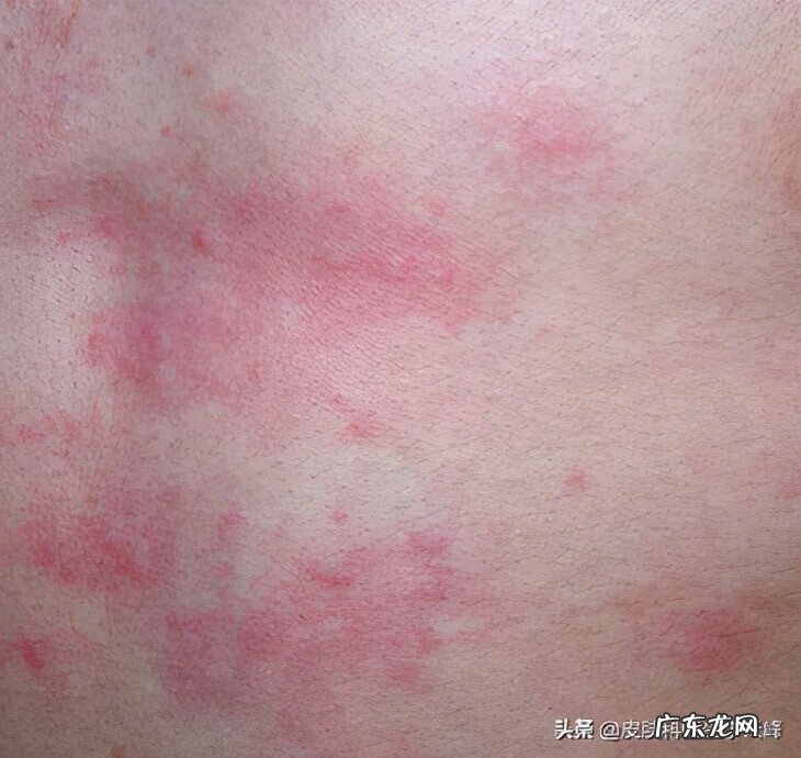 胆碱能性荨麻疹有什么症状 胆碱性荨麻疹什么症状