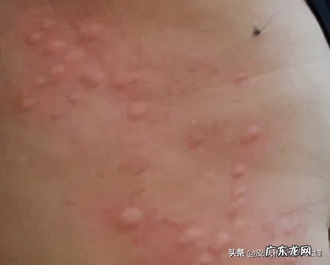 胆碱能性荨麻疹有什么症状 胆碱性荨麻疹什么症状