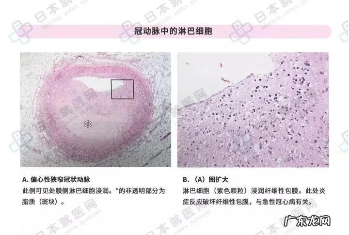 炎症是怎么引起的 炎症怎么办才能彻底消除