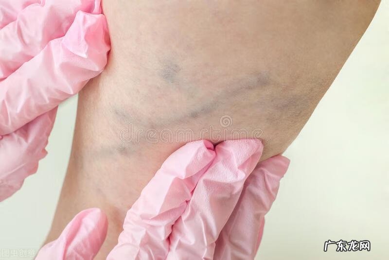 静脉曲张产生的原因 静脉曲张的原因有哪些