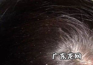 有头皮屑怎么样才能根治 有头皮屑怎么办用什么方法治疗好
